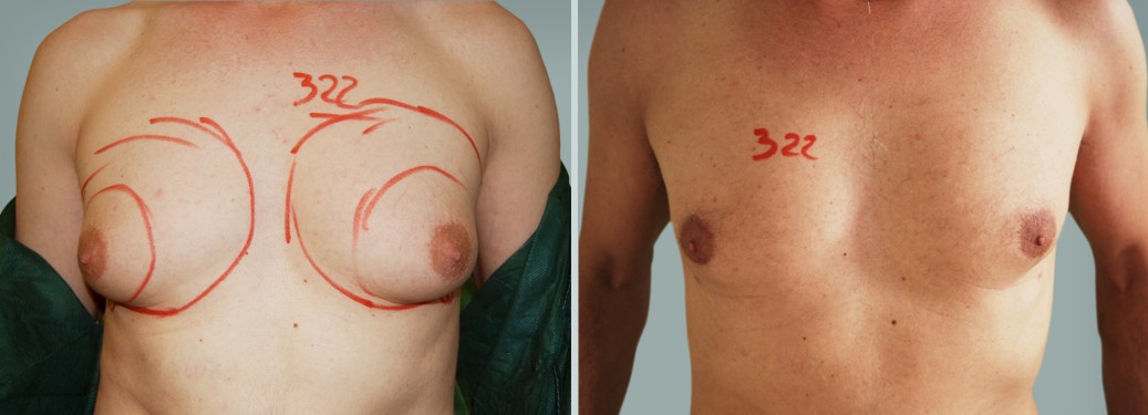 Foto prima e dopo Liposuzione Ginecomastia