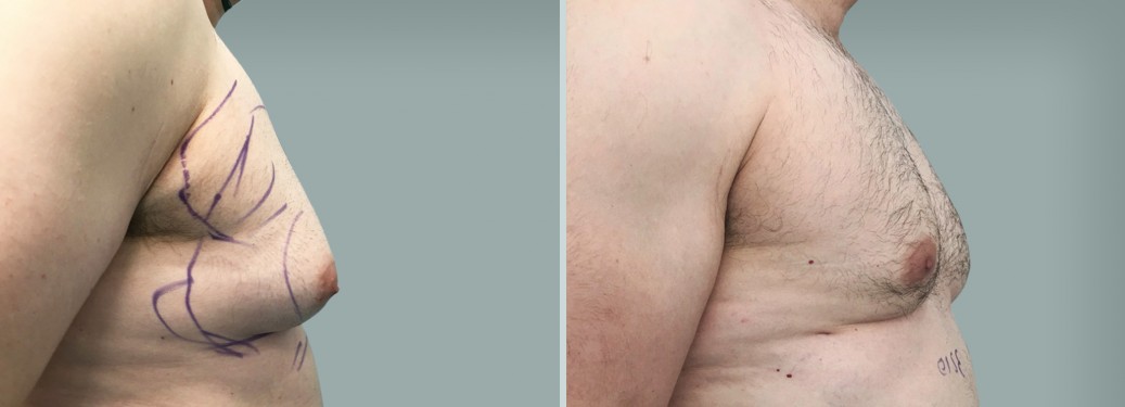 Foto prima e dopo Liposuzione Ginecomastia