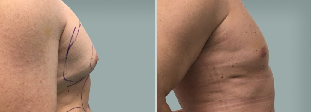 Foto prima e dopo Liposuzione Ginecomastia