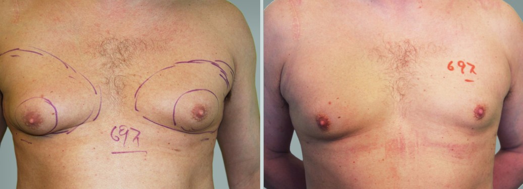 Foto prima e dopo Liposuzione Ginecomastia