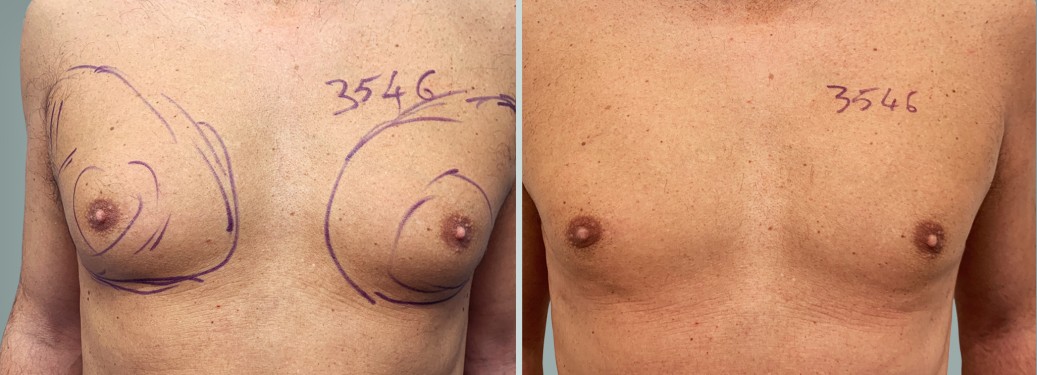 Foto prima e dopo Liposuzione Ginecomastia