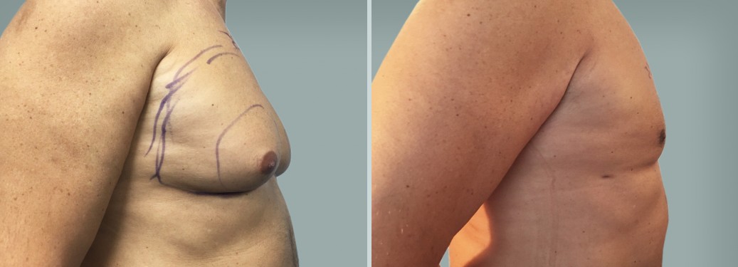 Foto prima e dopo Liposuzione Ginecomastia