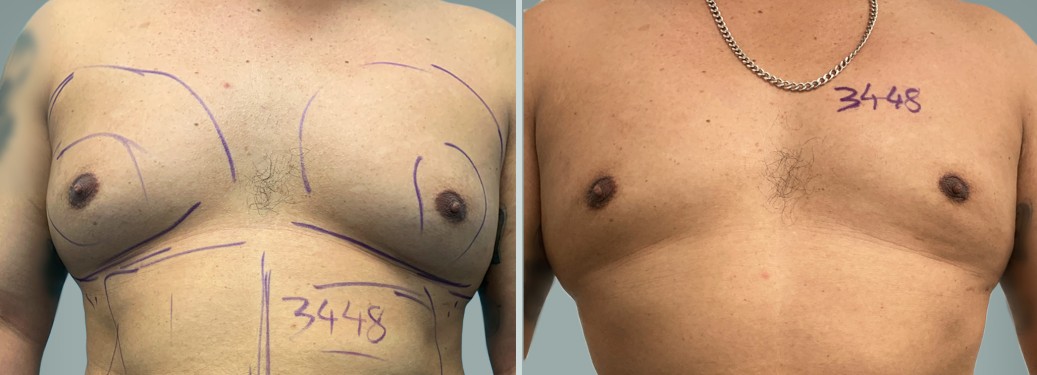 Foto prima e dopo Liposuzione Ginecomastia