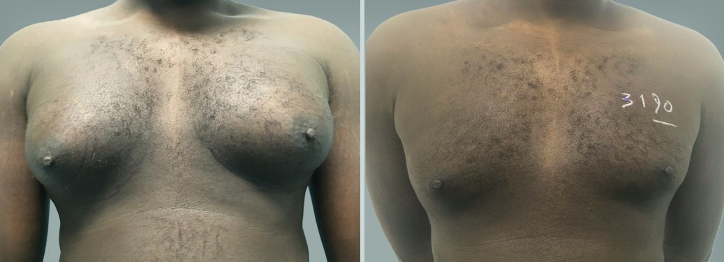 Foto prima e dopo Liposuzione Ginecomastia