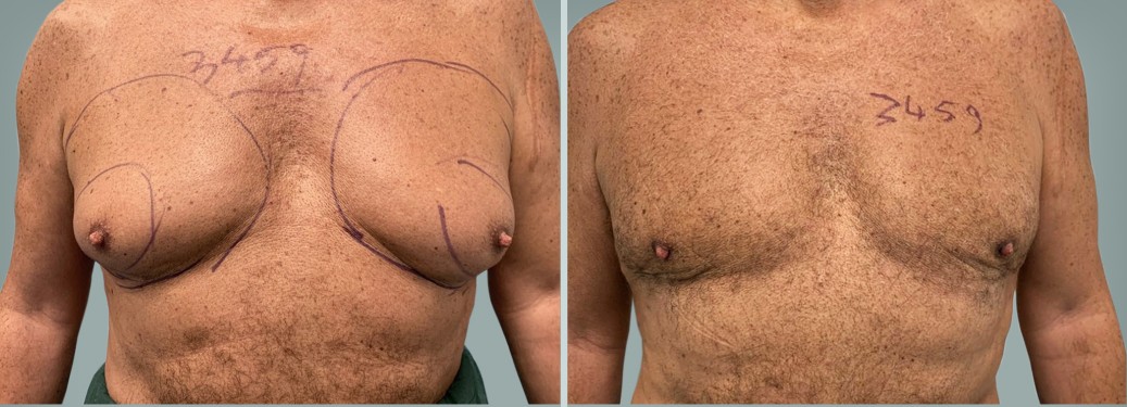 Foto prima e dopo Liposuzione Ginecomastia